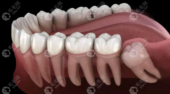般医生会建议四颗智齿都拔掉