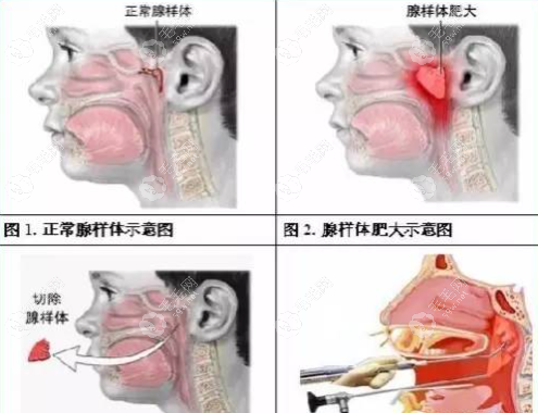 14岁腺样体面容和凸嘴怎么矫正59w.net