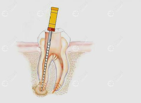 为什么牙齿做过根管治疗之后还会痛