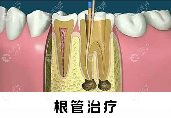 根管治疗几年后又痛怎么处理~毛毛网