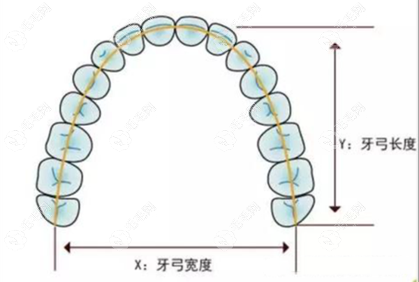 扩弓器矫正牙齿的大概多少钱?儿童活动扩弓费用3000起/固定2k