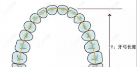 扩弓器矫正牙齿的大概多少钱?儿童活动扩弓费用3000起/固定2k