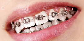 矫正牙齿要拔4颗牙,有什么影响吗?简单说下正畸拔4牙的弊端