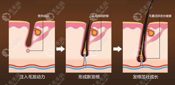 自然卷毛囊换直发毛囊