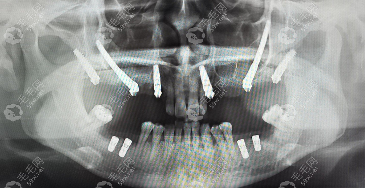 哈尔滨淇奥口腔穿颧穿翼种植