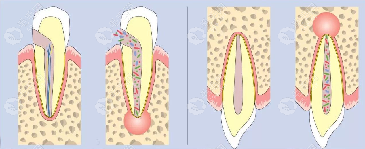 引起的牙齿根尖炎的原因~毛毛网