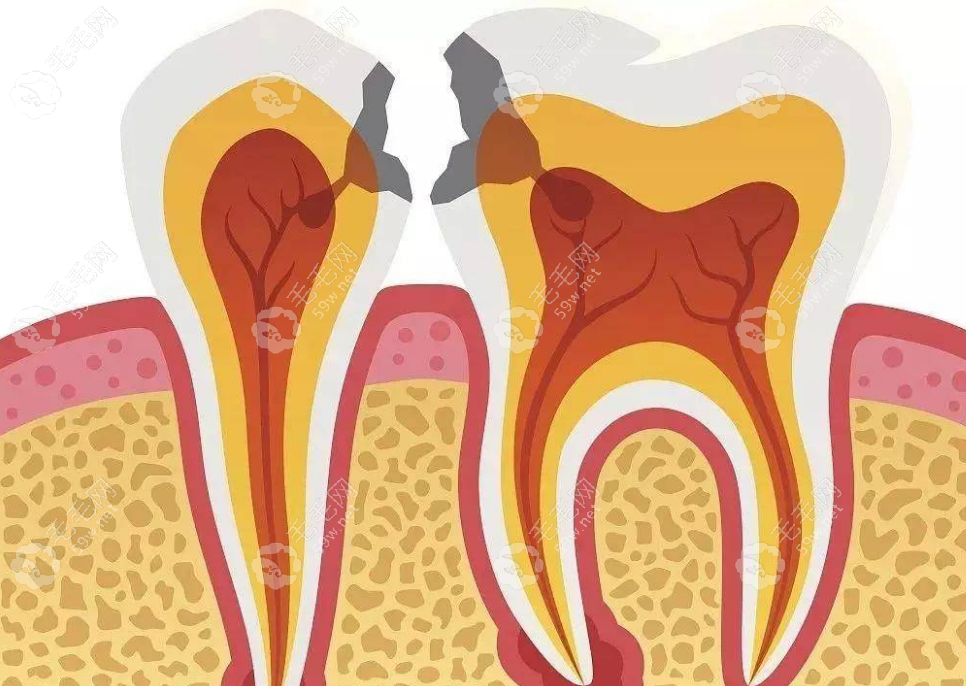 塞牙可能是因为牙齿邻面龋坏www.59w.net