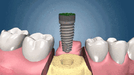 北京朝阳区种植牙价格表:2025年种一颗牙3k+/全口牙5-20万左右