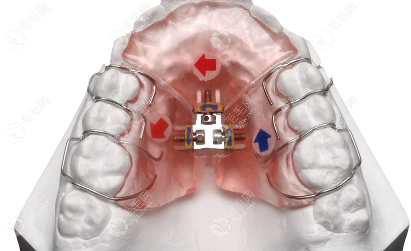 从儿童扩弓矫正牙齿的利弊来看:孩子戴扩弓整牙利大于弊