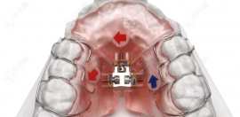 从儿童扩弓矫正牙齿的利弊来看:孩子戴扩弓整牙利大于弊