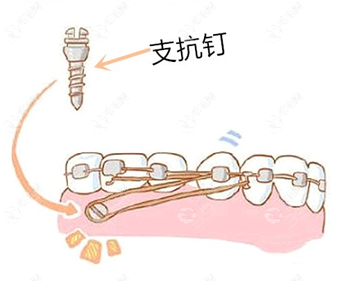 滁州牙齿矫正整个过程之打骨钉