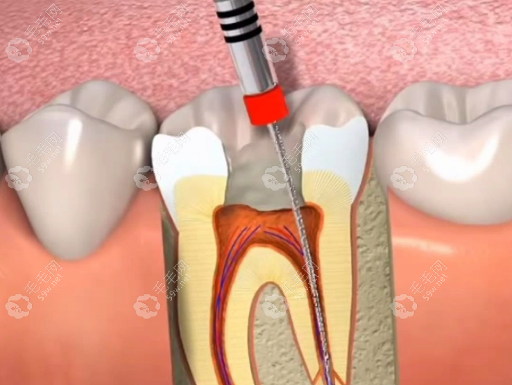 咿呀口腔根管治疗特色 毛毛网