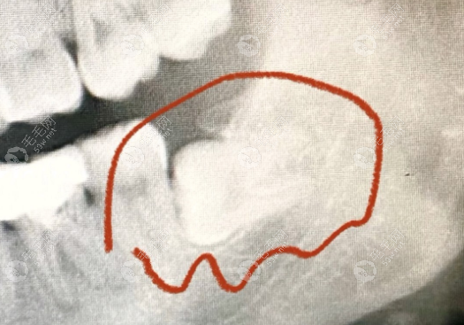 横生智齿医生建议不拔的原因揭晓,我拔横着的智齿后悔死了
