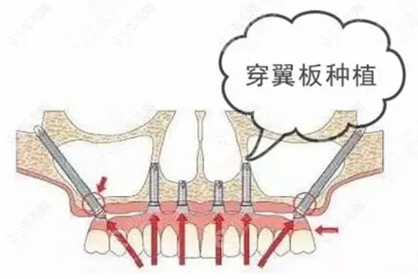 北京全口种植牙哪家医院好？中诺/劲松/钛植口腔都不错