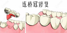 缺失一颗牙做3连桥的利弊:价格便宜,但是两边的牙会受伤害