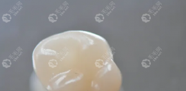 牙齿做嵌体一般多少钱一颗?树脂嵌体大约800+烤/全瓷嵌体1000+