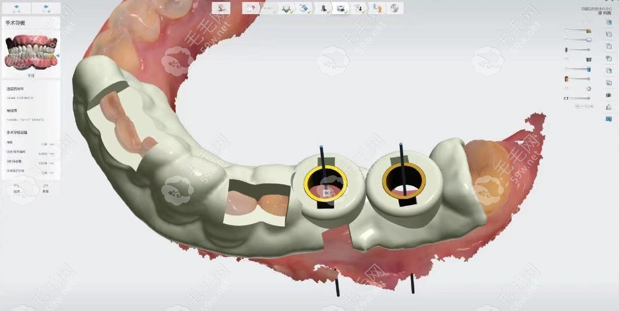 武汉中诺口腔3D导板种植牙的优势