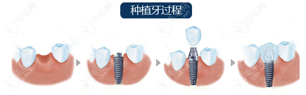 成都极光口腔种植牙哪个医生好www.59w.net