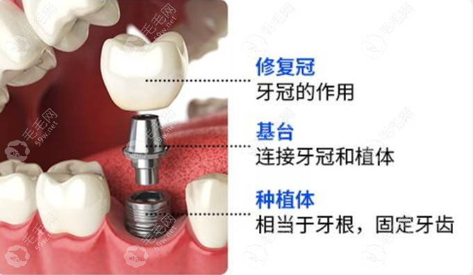 广州广大口腔种植牙4300元起一颗