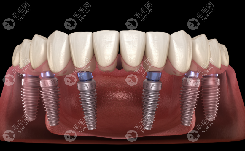 半口6颗种植牙修复过程