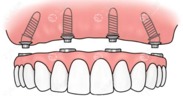 上半口种植牙四颗与六颗的区别:六颗植体更稳定但价格也高