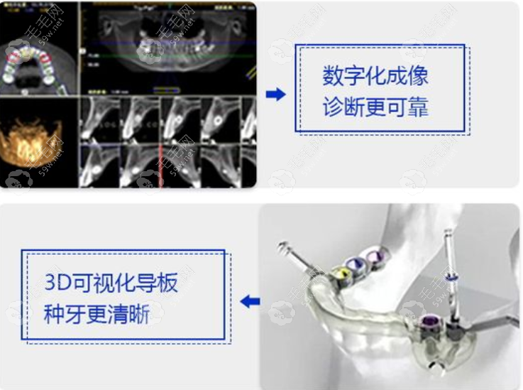 广大口腔医院数字化种植牙技术