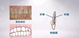 横向刷牙导致牙齿颈部缺损怎么办?无法自愈要及时修复+根管