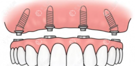 上半口种植牙四颗与六颗的区别:六颗植体更稳定但价格也高