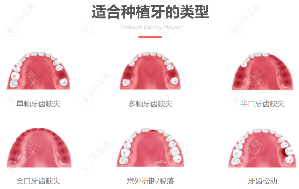 广州团圆口腔种植牙靠谱