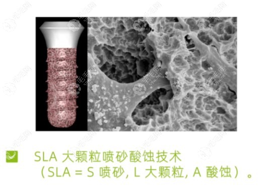 iti悦锆瑞锆种植体制作工艺不同