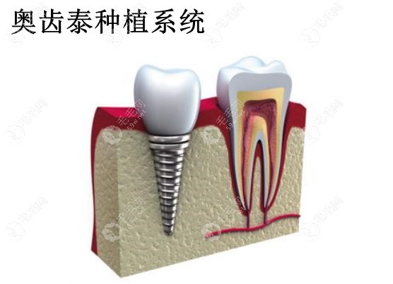 奥齿泰种植牙怎么样