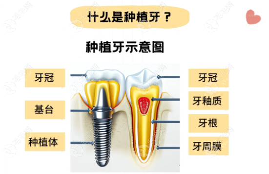 种植牙集采后质保时间变短