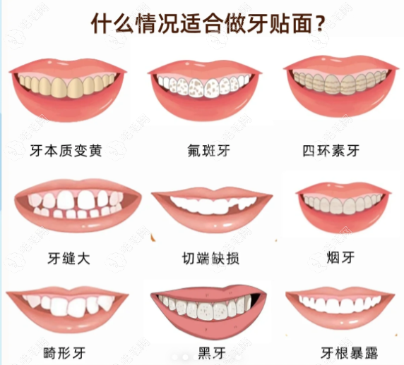 牙齿贴面适合人群有纳西