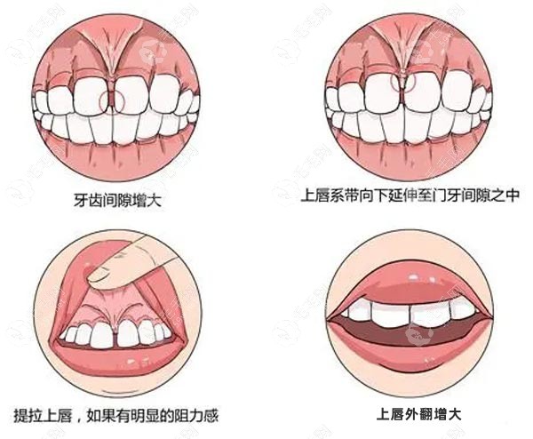 体张月鹏医生做唇系带手术的症状