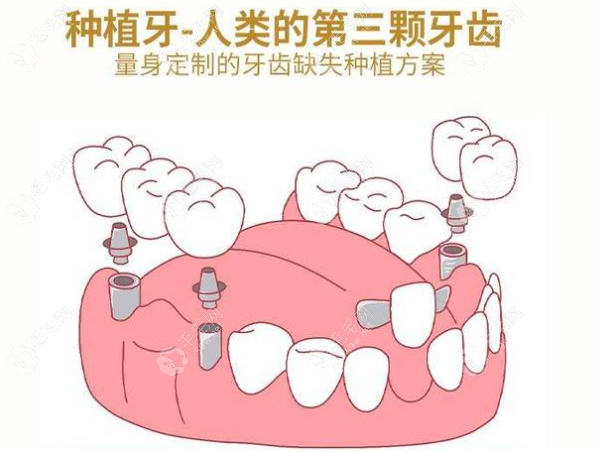 西安团圆口腔医院种植牙多少钱一颗