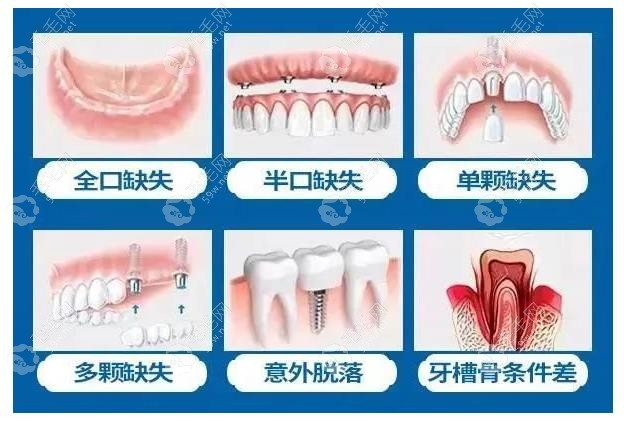 西安团圆口腔医院种植牙医生哪个好