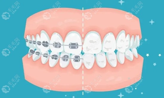 郑州牙套矫正牙齿多少钱 
