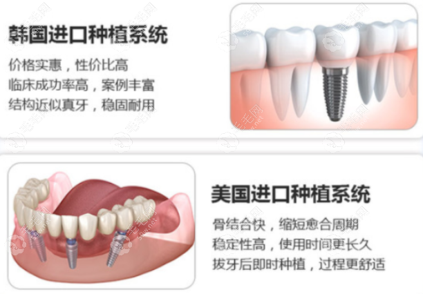 西安团圆口腔医院种植牙品牌型号