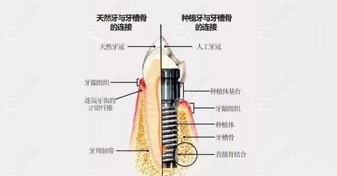 韩国登腾种植牙牙冠+基台