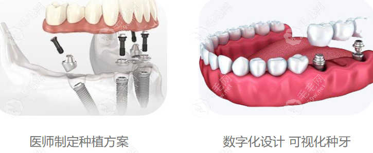 广州团圆口腔种植牙技术好