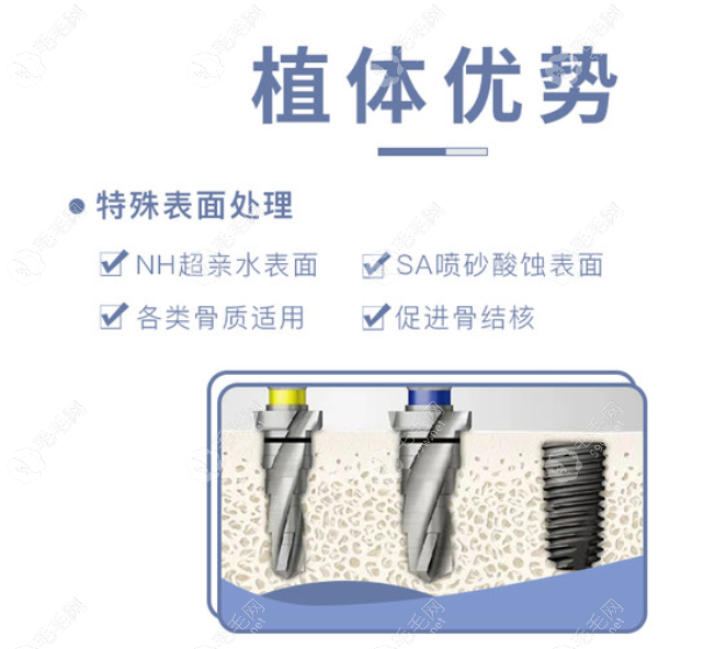 中诺口腔科种植牙骨结合时间短