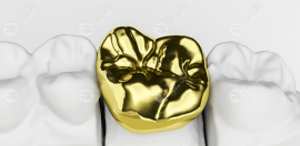 镶一颗牙要付三颗牙齿的钱合理吗多少钱?根据镶牙方式而定