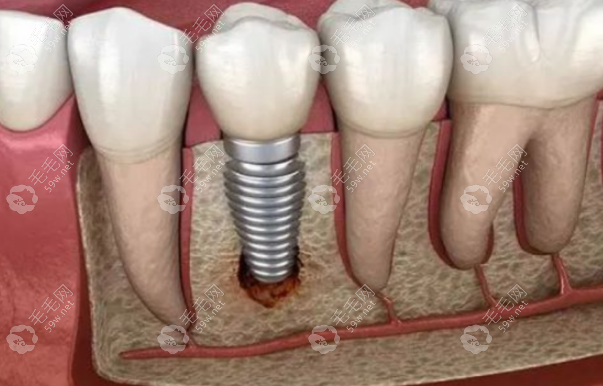 2000一颗的种植牙能用 59w.net