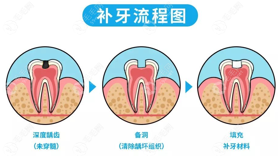 20岁补牙材料怎么选择 毛59w.net毛网