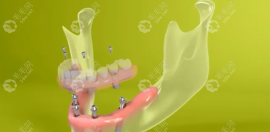 50-60种牙2025价格表,50-60岁满口上下种8颗8w+/种12颗10w+