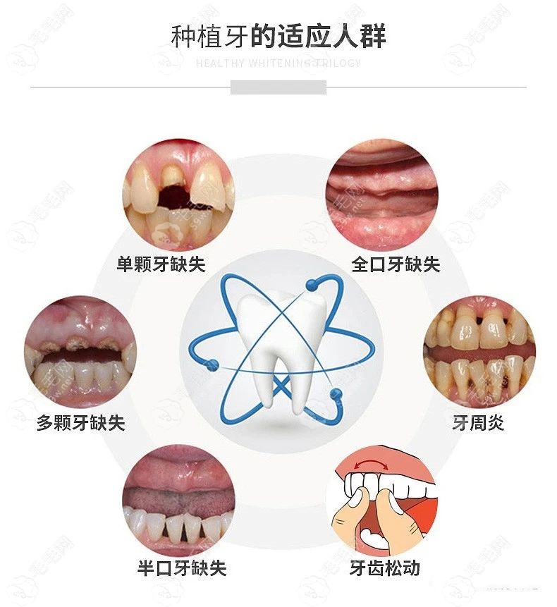 半口种植牙后的感受:半口种植牙4万元不贵比假牙套好还耐用