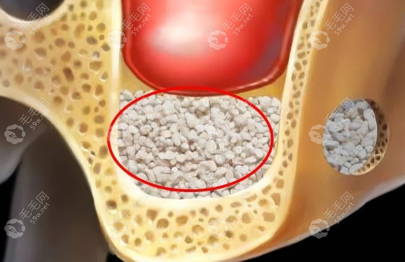 种植牙骨粉的作用