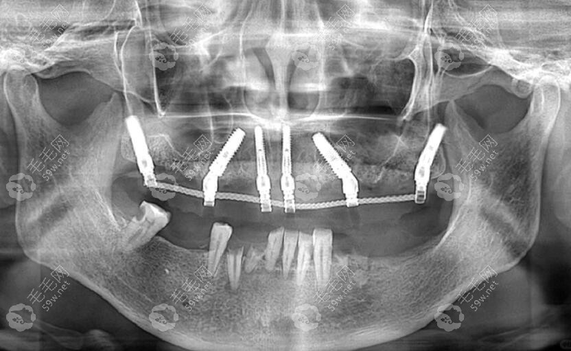 半口6颗种植牙图片大全