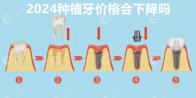 2024种植牙价格 毛毛网