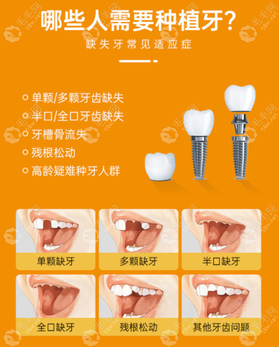 40-50种牙2023价格表分享